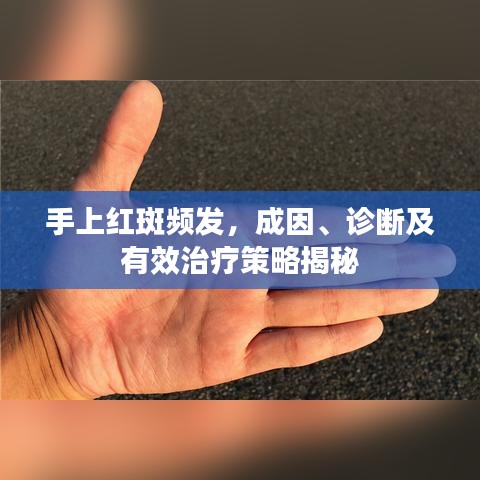 手上紅斑頻發(fā)，成因、診斷及有效治療策略揭秘