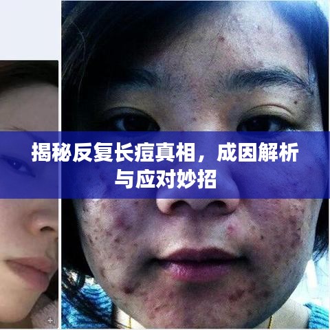 揭秘反復長痘真相，成因解析與應(yīng)對妙招