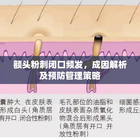 額頭粉刺閉口頻發(fā)，成因解析及預防管理策略