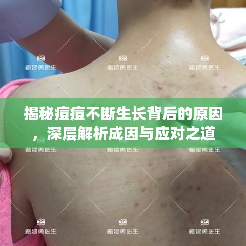 揭秘痘痘不斷生長(zhǎng)背后的原因，深層解析成因與應(yīng)對(duì)之道